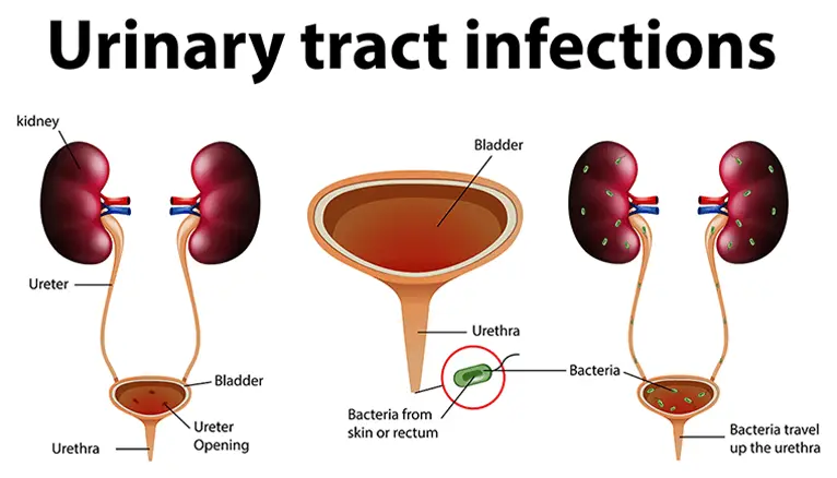 What is Urinary Tract Infections (UTIs)