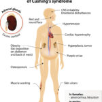 What is Cushing’s Syndrome?