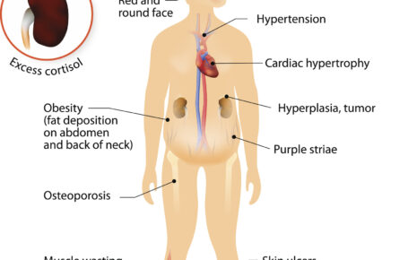 What is Cushing’s Syndrome?