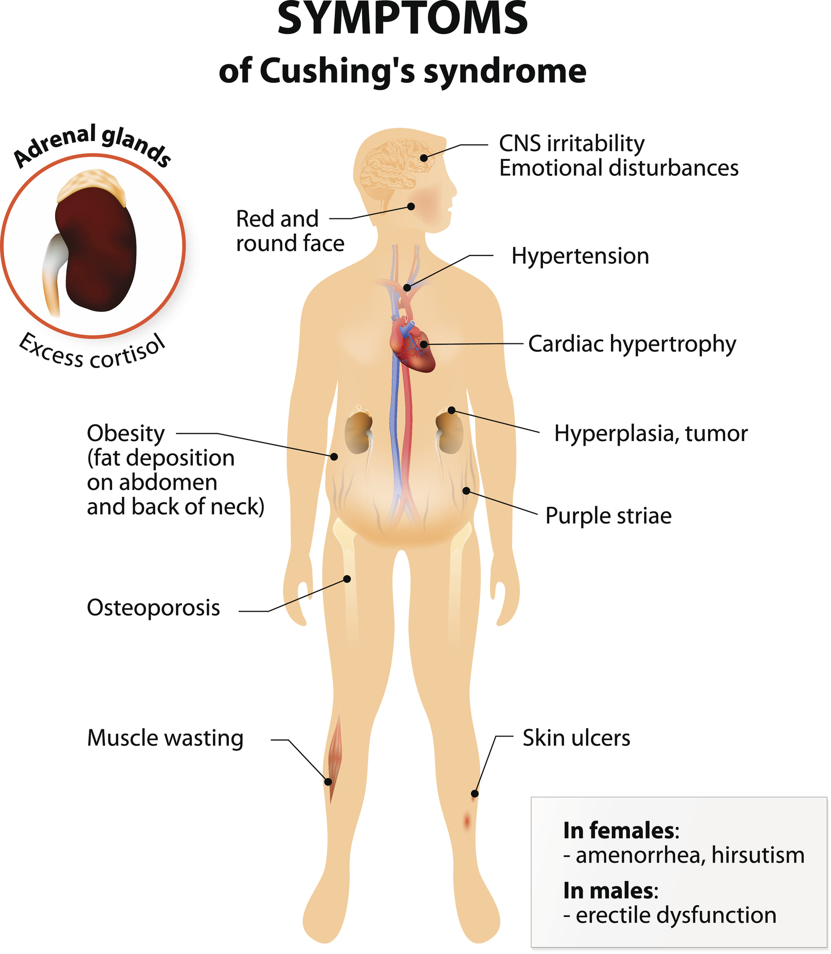 what-is-cushing-s-syndrome-medicine-for-world
