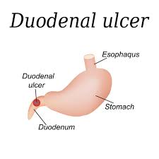 What is Duodenal Ulcers
