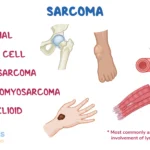 What is Epithelioid Sarcoma