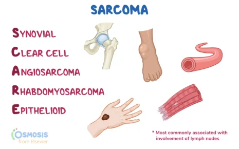 What is Epithelioid Sarcoma
