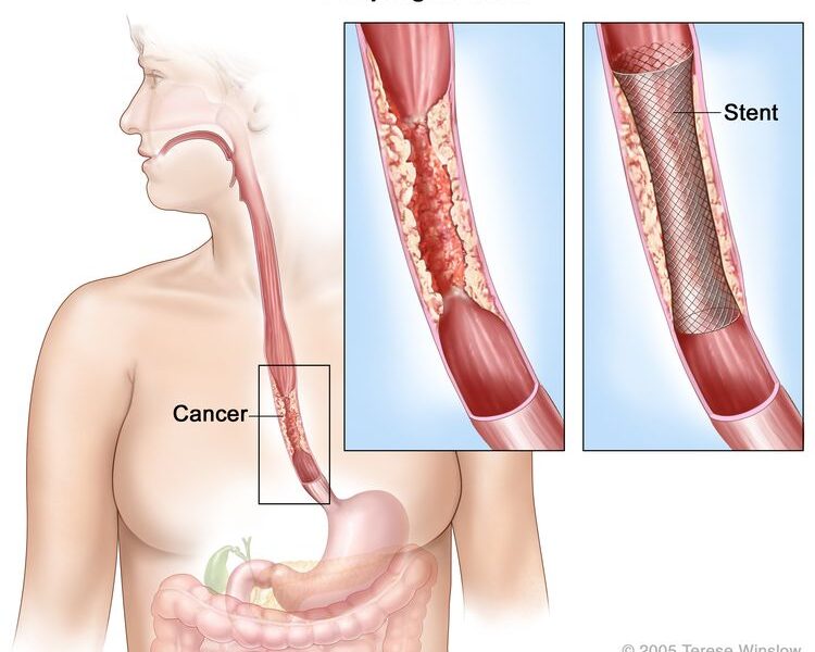 What Causes Esophagus Cancer