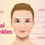 What is Facial Wrinkles
