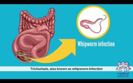 What is Trichuriasis?