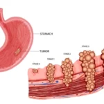What is Gastric Cancer