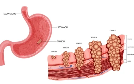 What is Gastric Cancer