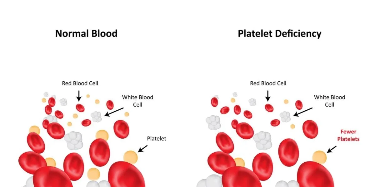 What is Thrombocytopenia