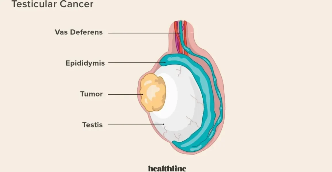 What is Testicular Cancer