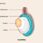 What is Testicular Cancer