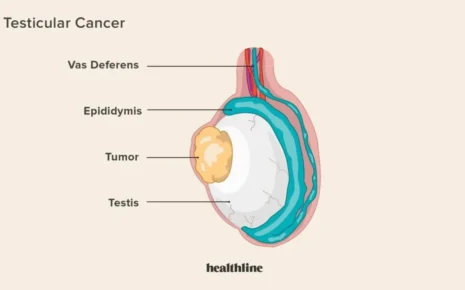 What is Testicular Cancer