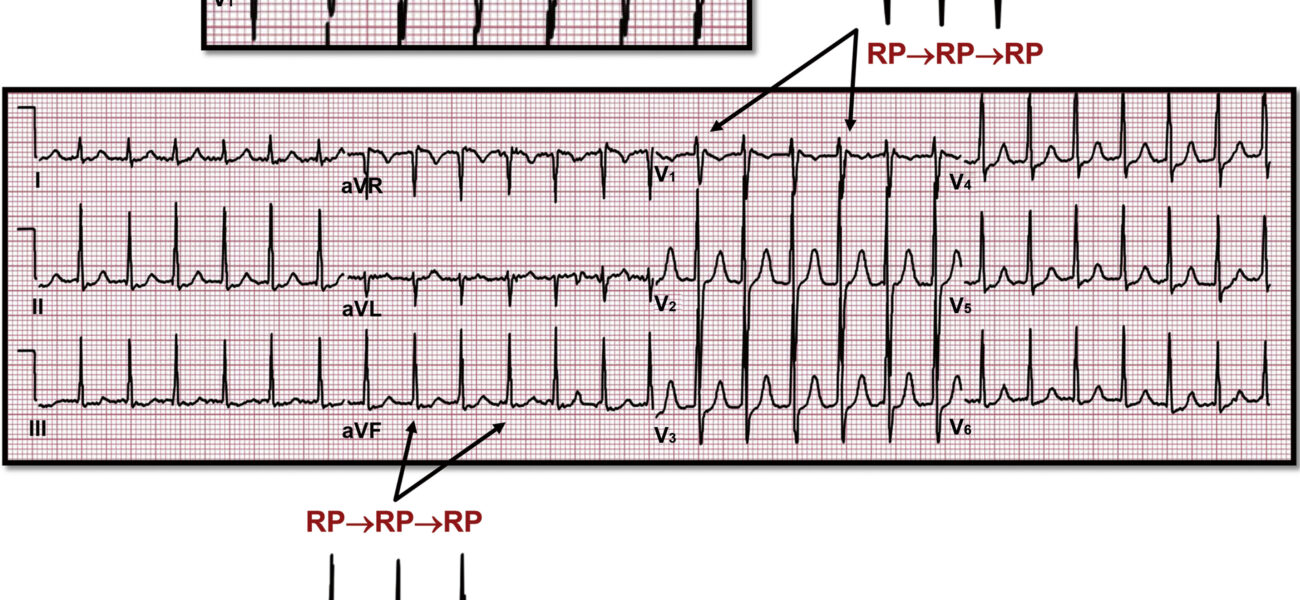 What is Supraventricular Arrhythmias