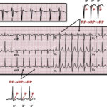 What is Supraventricular Arrhythmias