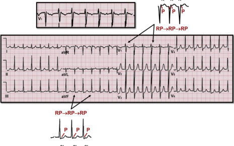 What is Supraventricular Arrhythmias