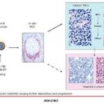What is Mantle Cell Lymphoma