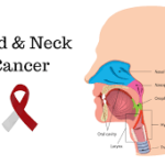 What is Head and Neck Cancer