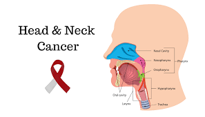 What is Head and Neck Cancer