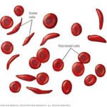 What is Sickle Cell Anemia