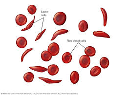 What is Sickle Cell Anemia