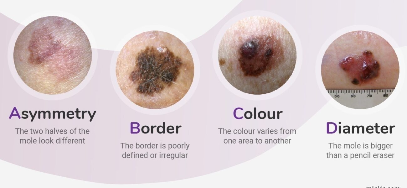 What is Melanoma?