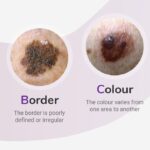 What is Melanoma?
