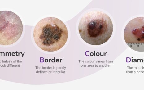 What is Melanoma?