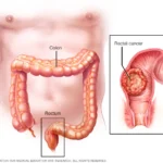 Rectum Cancer