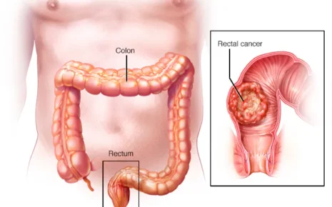 Rectum Cancer