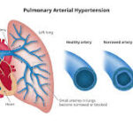 What is Pulmonary Arterial Hypertension