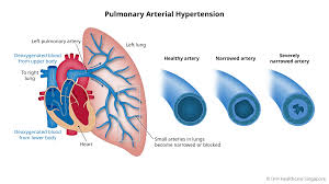 What is Pulmonary Arterial Hypertension