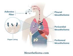 What is Mesothelioma Cancer