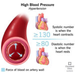 What is High Blood Pressure