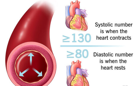 What is High Blood Pressure
