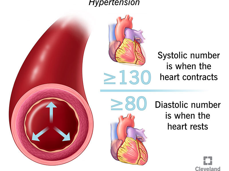 What is High Blood Pressure