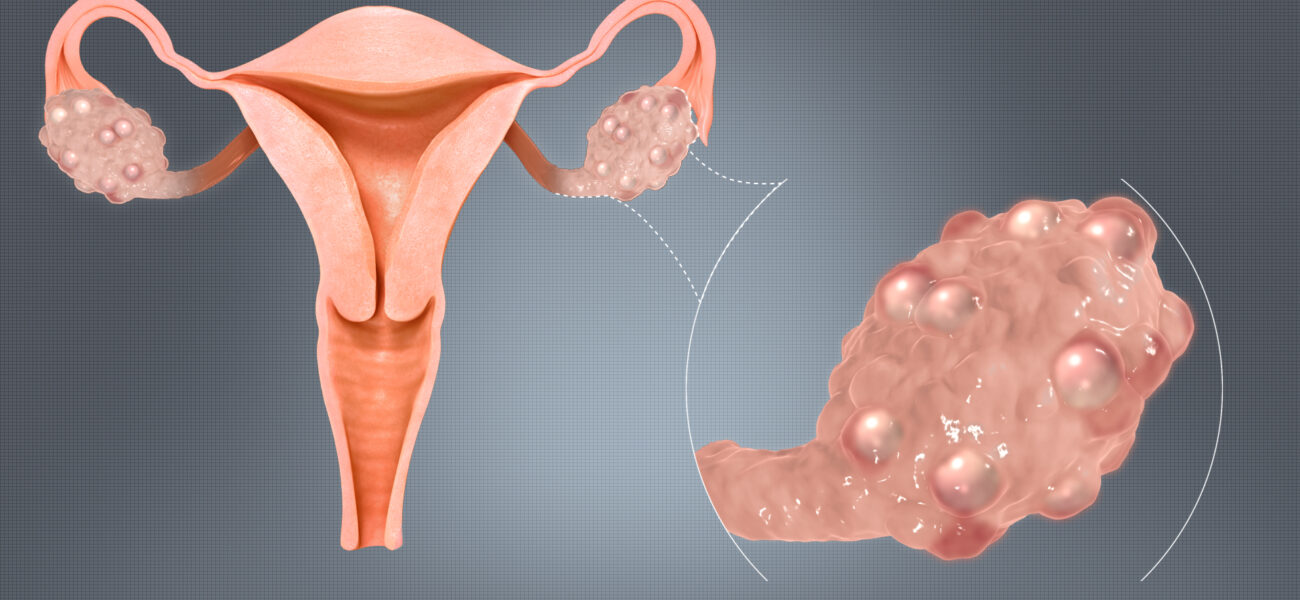 Polycystic Ovarian Syndrome