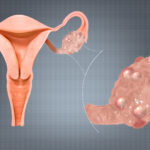 Polycystic Ovarian Syndrome