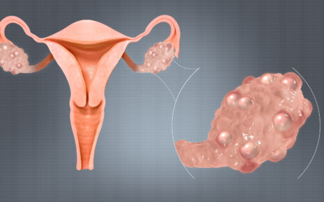 Polycystic Ovarian Syndrome