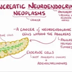 Pancreatic Neuroendocrine Tumors