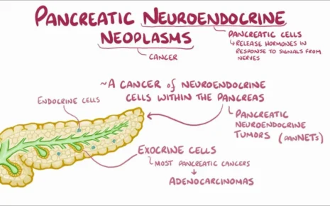 Pancreatic Neuroendocrine Tumors