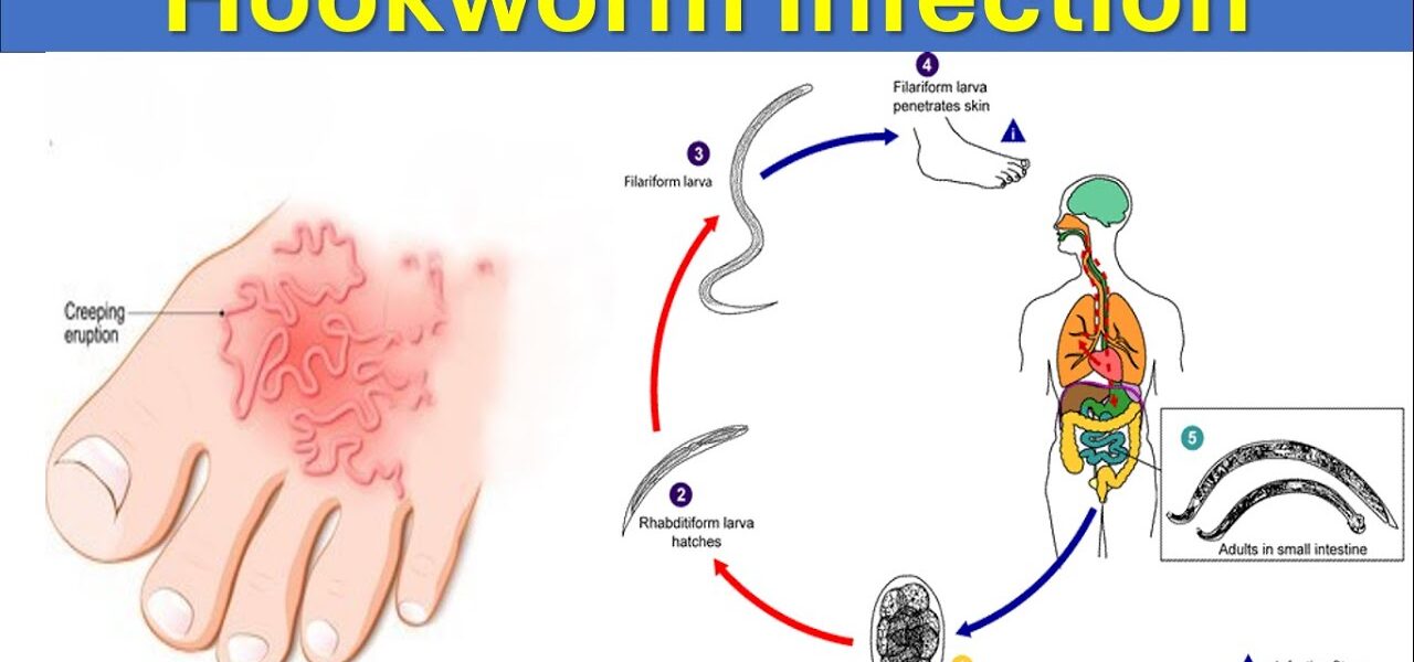 What is Hookworm Infections