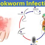 What is Hookworm Infections