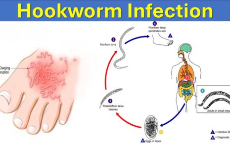 What is Hookworm Infections