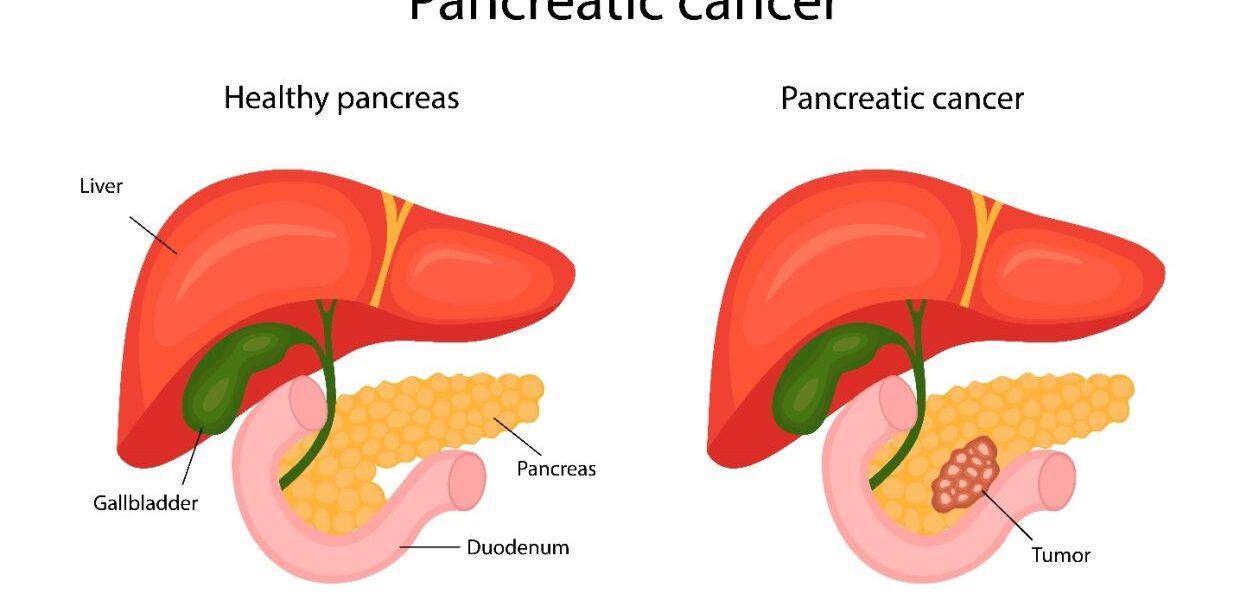 Pancreatic Cancer