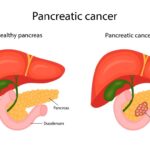 Pancreatic Cancer