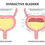 Overactive Bladder