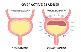 Overactive Bladder