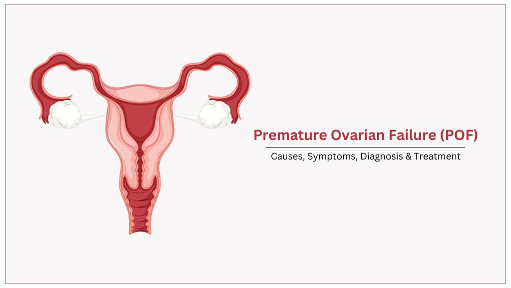 Ovarian Failure