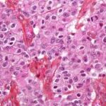 Oligodendroglioma