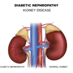 What is Nephropathy?